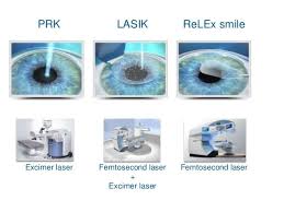 Laser Vision Correction Laser Vision Correction Laser Vision Lasik Eye Surgery