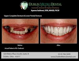Complete dentures are used to replace all the teeth, while partial dentures are used alongside some. Affordable Dental Care For Your Entire Family Accepting New Patients Partial Dentures Dental Cosmetics Implant Dentistry