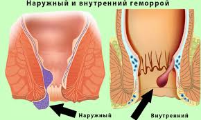 Mozhet Li Byt Temperatura Pri Gemorroe Prichiny I Lechenie Oficialnyj Sajt Gbuz Rodilnyj Dom 2 G Magnitogorsk