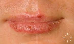 Image result for Erythema Multiforme Major