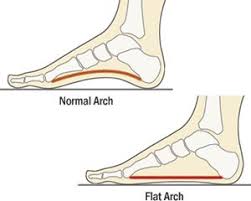 How To Help Fallen Arches Or Flat Feet Inspirehappy Fallen Arches Flat Feet Flat Feet Exercises