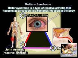 Check spelling or type a new query. Reiter S Syndrome Reactive Arthritis Everything You Need To Know Dr Nabil Ebraheim Youtube