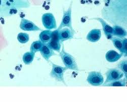 Nci Bethesda System 2001 Squamous Mnemonics Electron Microscope