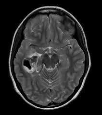 Patients have shorter survival rates when compared to those with who grade ii pleomorphic xanthoastrocytoma. File Pleomorphic Xanthoastrocytoma 002 Jpg Wikipedia