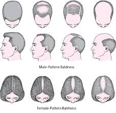 Endocrinologists are licensed medical professionals who specialize in the endocrine system, hormones, and the diseases that result from hormonal imbalance. Quick Facts Hair Loss Merck Manuals Consumer Version