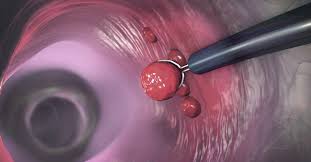 Colon cancer affects both men and women, and all unfortunately, at the onset, colon cancer has few, if any, symptoms. Cancer Du Colon Quels Symptomes Et Quel Depistage Contre La Maladie