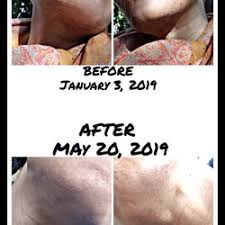 Avx500 professional electrolysis machine for permanent hair removal the galvanic specifications for the avx500 are the same as the aavexx 600, complete with single or multiple modes, foot switch, overload protection and so on. Best Electrolysis Near Me July 2021 Find Nearby Electrolysis Reviews Yelp