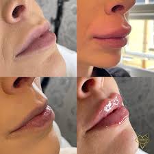 My Lip Fillers Migrated Into My Chin — But I'Ll Never Stop