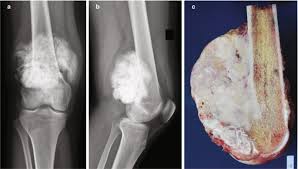 Image result for Osteosarcoma
