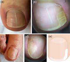Image result for Onycholysis feet