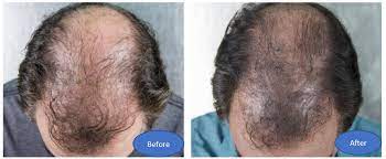 In this post, i'm going to introduce you to bimatoprost. New Company Triple Hair Follicle Thought