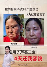 紧急讯息‼️ 我脸被烫伤了怎么办？ 一看照片， 天呐～～ 赶快拿3宝来涂了很多人会以为我们的3宝只是营销效应嫌我的贵