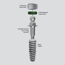 O Ring Abutments Kka Complete Dental Implant Solutions