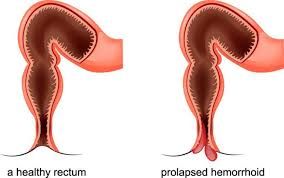 Image result for Rectal prolapse