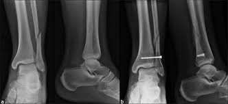 These muscles work together to produce movements such as standing, walking, running, and jumping. X Ray Lower Third Leg Bones With Ankle Joint Anteroposterior And Download Scientific Diagram