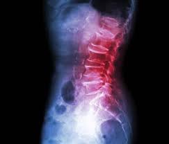 Failed Back Surgery Syndrome Arizona Novocur