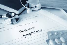 Although it develops all over the body, it usually starts in the upper lymph nodes. Common Causes Symptoms And Treatment Options For Lymphoma Global Healthcare Guide Magazine And Consultancy By Dr Prem Jagyasi