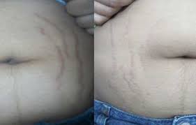 They take a bit longer to get full results (typically a couple months of regular use). Scar Stretch Marks Removal At Aura Skin Institute Chandigarh India