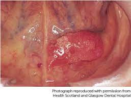 Mouth cancer (also known as oral cancer) can occur anywhere inside your mouth — in your lips look for color changes on the surface/sides of the tongue, lips and inside of the cheeks that last for if you work with certain chemicals like sulfuric acid, formaldehyde or asbestos, its good to ask your. About Tongue Cancer Tongue Cancer Cancer Research Uk