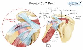 Image result for Rotator Cuff Rupture
