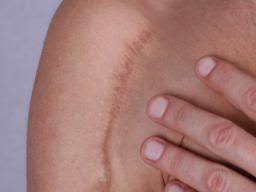 We did not find results for: How To Get Rid Of Keloids Home Remedies Treatment And Tips