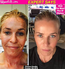 Chelsea handler was born in livingston, new jersey, to a she was the youngest of six children. Chelsea Handler S 3000 Anti Aging Remedy Will It Make You Look 5 10 Years Younger Laser Skin Treatment Laser Face Treatment Profractional Laser