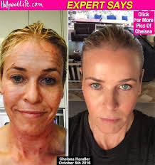 Select from premium chelsea handler of the highest quality. Chelsea Handler S 3000 Anti Aging Remedy Will It Make You Look 5 10 Years Younger Laser Skin Treatment Laser Face Treatment Profractional Laser