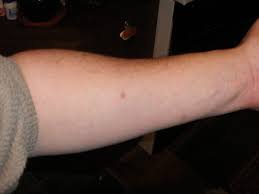 Let's take one simple example today to explain the process which will help to when writing test scenarios, we classify them into positive and negative conditions. File Negative Mantoux Test Jpg Wikipedia