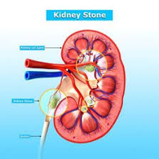 Kidney Stone Removal What Causes Kidney Stones Kidney Stones Remedy Kidney Stones