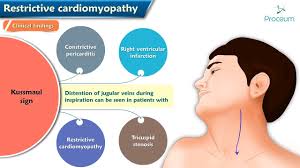 Image result for Restrictive Cardiomyopathy