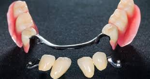 Maybe you would like to learn more about one of these? Azusa Dentures A New Smile Dentures In Azusa Dentist Azusa 91702
