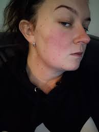 My head and face skin feel raw like road rash