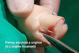 Durerea poate sau nu sa fie prezenta, in functie de gradul de neuropatie periferica. Unghie Incarnata Cum Se Taie Corect O Unghie La Picior Cum Prevenim