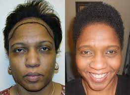 Hello everyone, i finally made the decision to get a hair transplant i have reached a point where i realized my traction alopecia was irreversible. African American Woman Hair Transplant Reviews