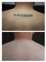 We offer permanent tattoo and cosmetic makeup removal in a professional medical grade environment using the quanta q plus c laser system with great success. Houston Dermatologist Explains How Tattoo Removal Works