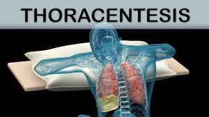 Image result for Thoracentesis