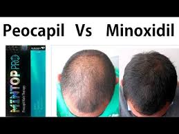 Pls watch this video to know which is more suitable for your. Minoxidil Vs Procapil For Hair Fall Hair Loss Male Female Which Is Best Youtube