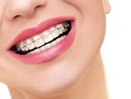 How do you get free braces in south africa. How The Process For Six Months Smiles In Framingham Works Framingham Family Dental Care