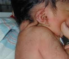 Image result for Webbed Neck