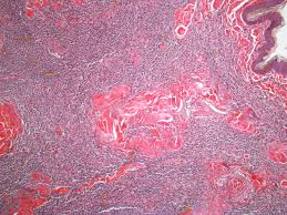 Human Round Cell Tumor H E Tissue Types Celestial Bodies Tumor