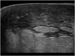 What does a cancerous breast lump look like on ultrasound? 5 2 11 Inflammatory Carcinoma Ultrasound Cases