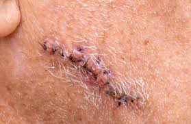 Multicenter prospective cohort study of 20 management of periocular basal cell carcinoma: What Exactly Is Mohs Surgery Boston Mohs Surgery Krauss Dermatology