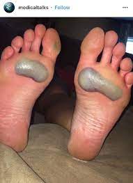 What to do with a blood blister on toe. Blood Blisters On Feet Shaky Video In Comments Popping