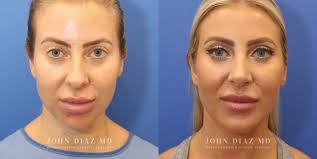 Beverly Hills Plastic Surgeon