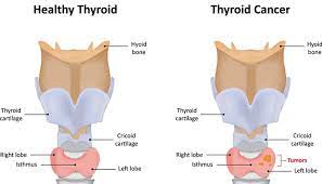 If the mass compresses the windpipe (trachea), these dogs may present with difficulties breathing or coughing. Common Thyroid Problems In Dogs And What To Do About Them
