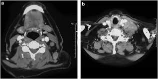 Patient instructions for ct simulation. Metastatic Prostate Cancer Presenting As An Asymptomatic Neck Mass Prostate Cancer And Prostatic Diseases
