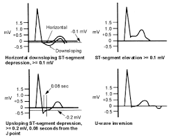 Ordering And Understanding The Exercise Stress Test