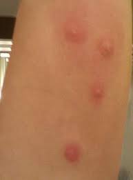 Image result for Flea Bite