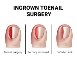 Image result for Toenail Removal