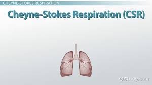 Image result for Cheyne-Stokes Respiration
